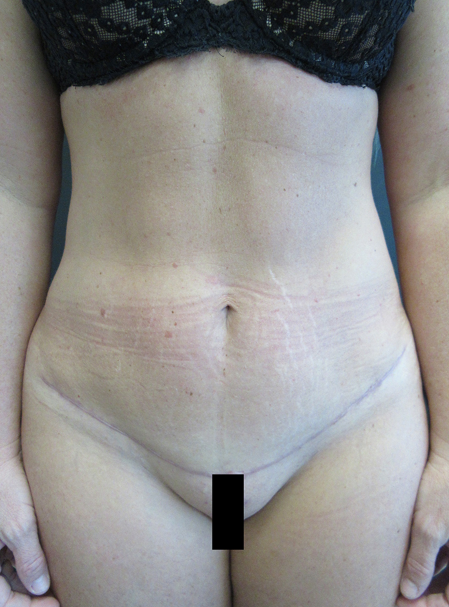 Tummy Tuck case #4185