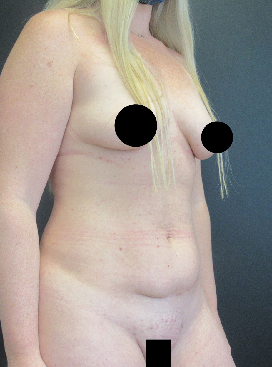 Tummy Tuck case #4185