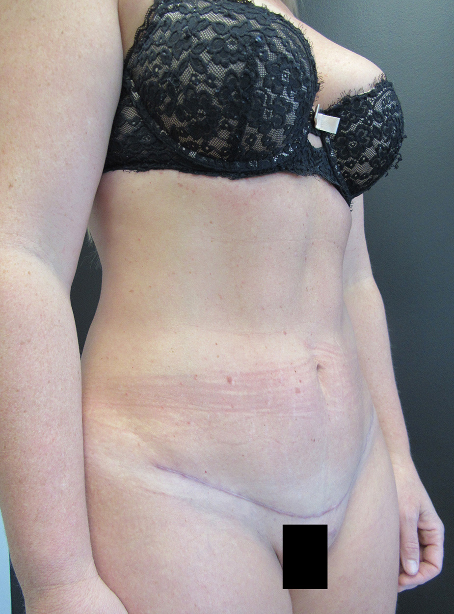 Tummy Tuck case #4185