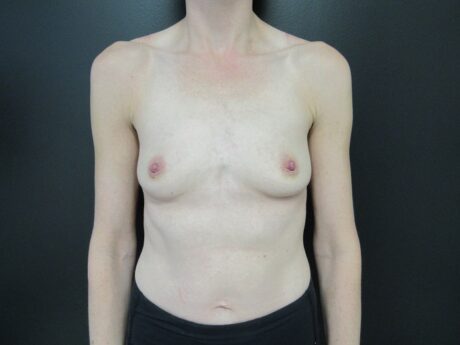 Breast Augmentation case #4709