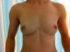 Breast Augmentation case #4714