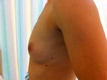 Breast Augmentation