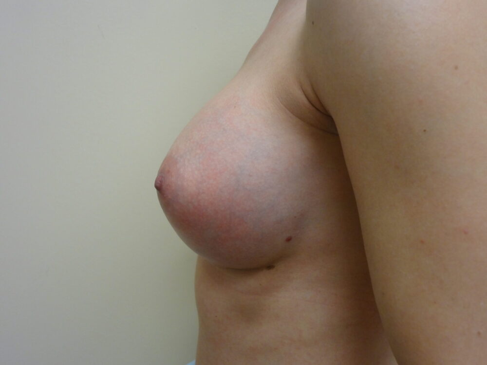 Breast Augmentation case #4714