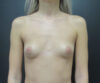 Breast Augmentation case #4726