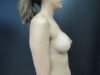 Breast Augmentation case #4740