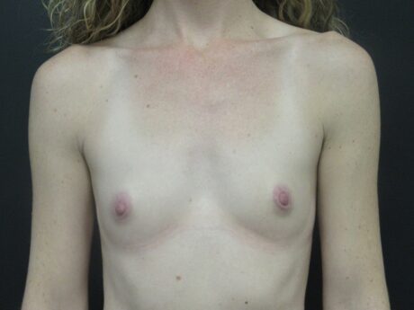Breast Augmentation case #4772