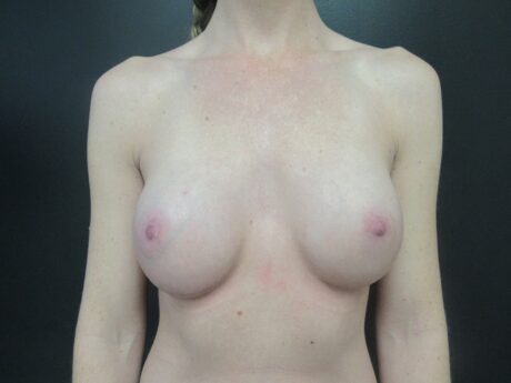 Breast Augmentation case #4772