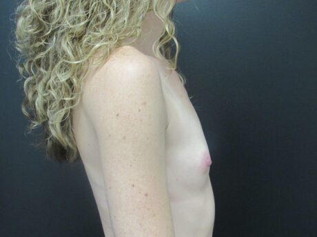 Breast Augmentation case #4772