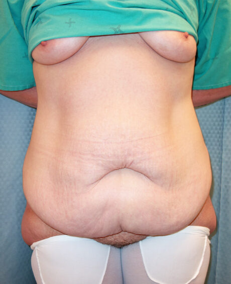 Tummy Tuck case #4858