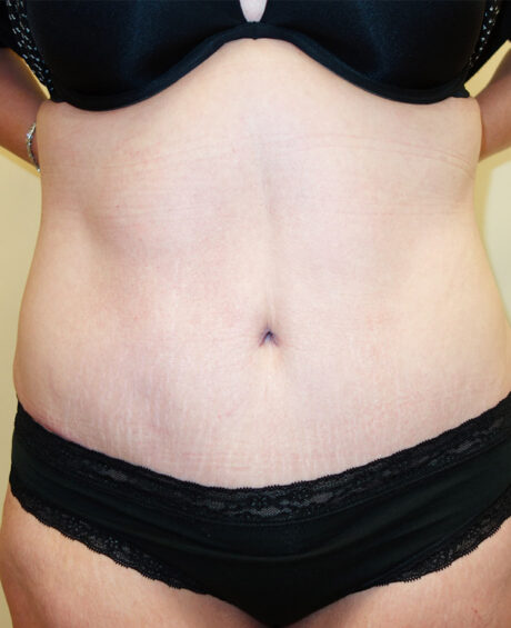 Tummy Tuck case #4858