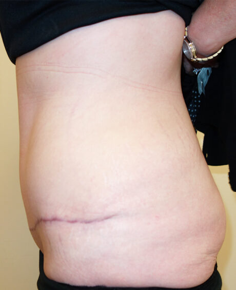 Tummy Tuck case #4858