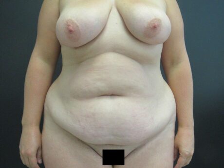 Tummy Tuck case #4864