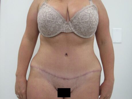 Tummy Tuck case #4864