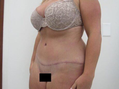 Tummy Tuck case #4864