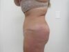 Tummy Tuck case #4864