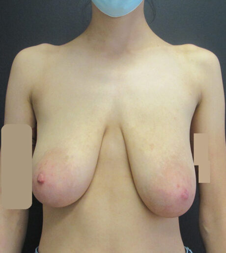 Breast Lift case #4957