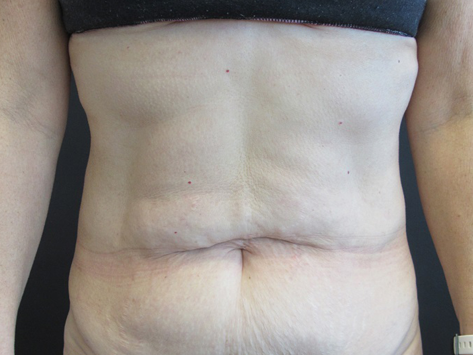 Tummy Tuck case #4901