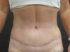 Tummy Tuck case #4901