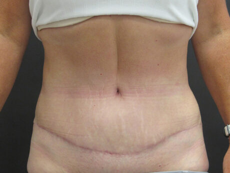 Tummy Tuck case #4901