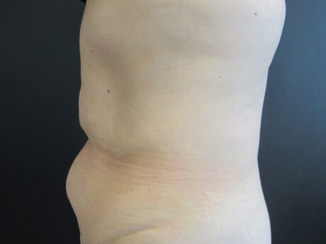 Tummy Tuck case #4901