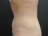 Tummy Tuck case #4901