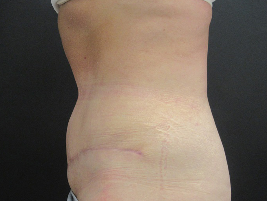 Tummy Tuck