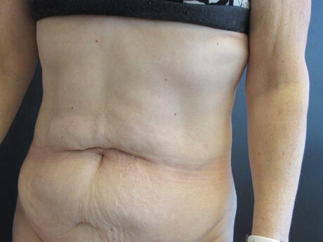 Tummy Tuck case #4901