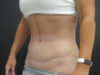 Tummy Tuck case #4901