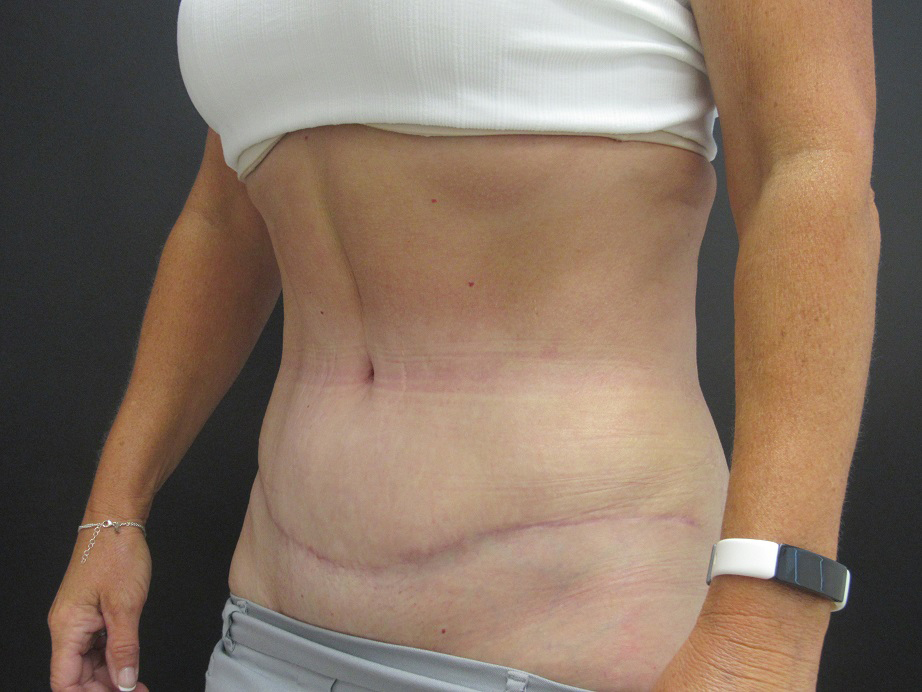 Tummy Tuck