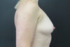 Breast Augmentation case #4908