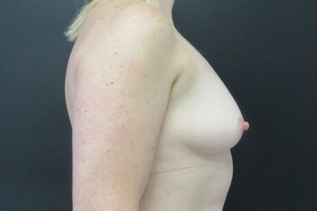 Breast Augmentation case #4908