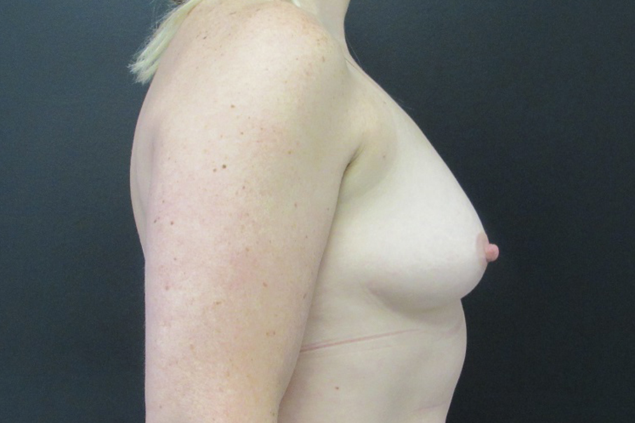 Breast Augmentation