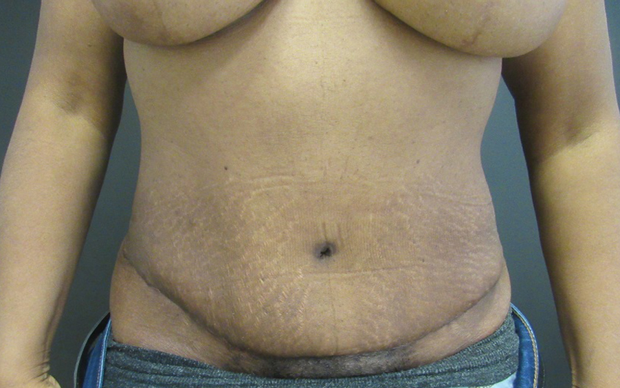 Tummy Tuck case #4894