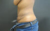 Tummy Tuck case #4894