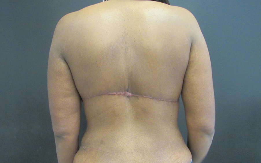 Tummy Tuck case #4894