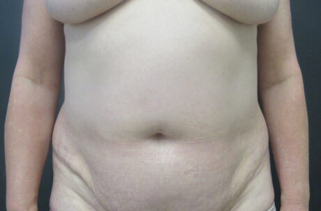 Tummy Tuck case #4922