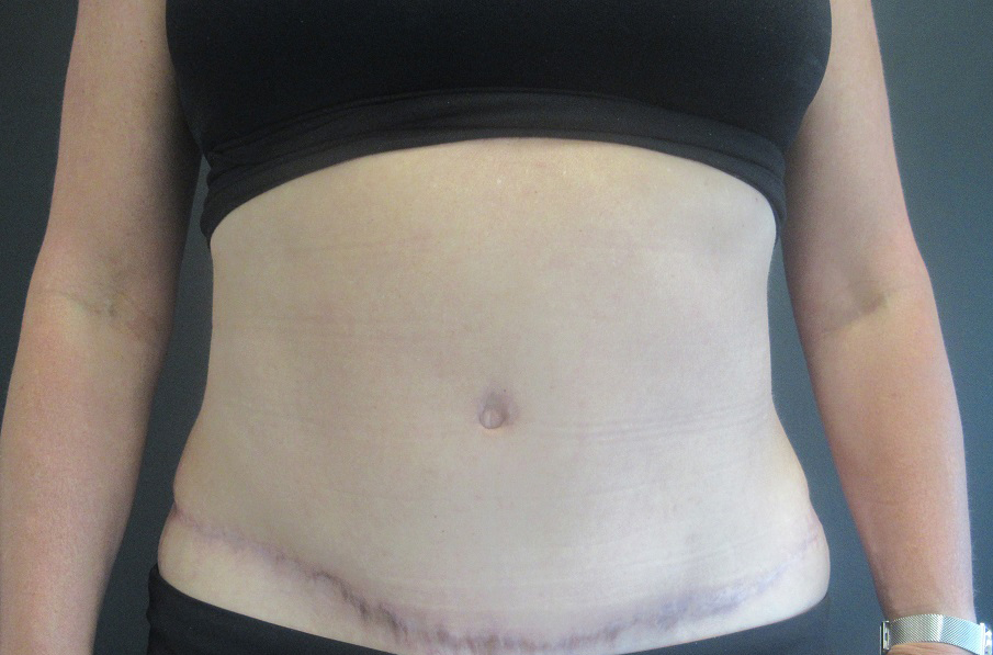 Tummy Tuck case #4922