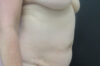 Tummy Tuck case #4922