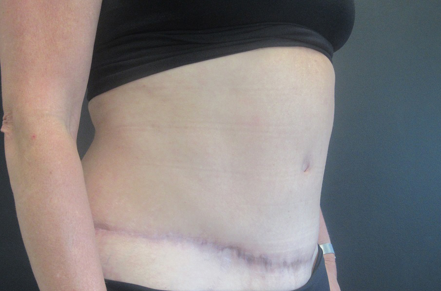 Tummy Tuck case #4922