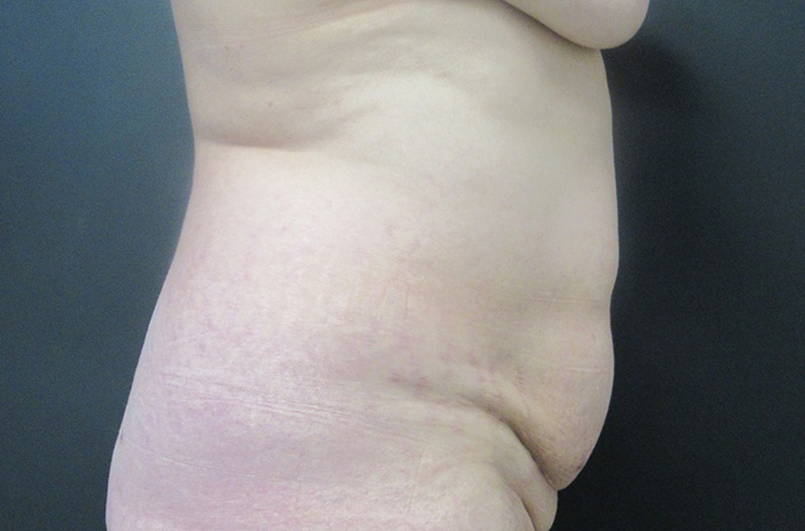 Tummy Tuck case #4922