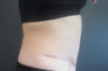 Tummy Tuck case #4922