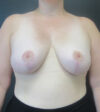 Breast Lift case #4938