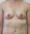 Breast Augmentation case #4881