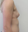 Breast Augmentation case #4881