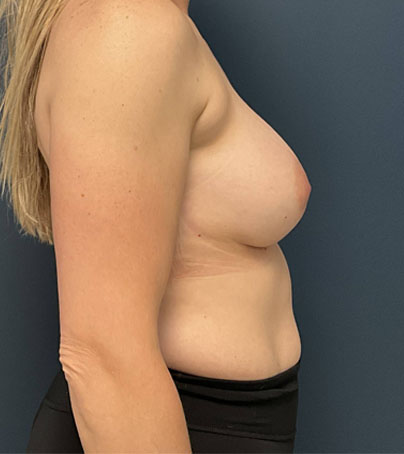 Breast Augmentation case #4881