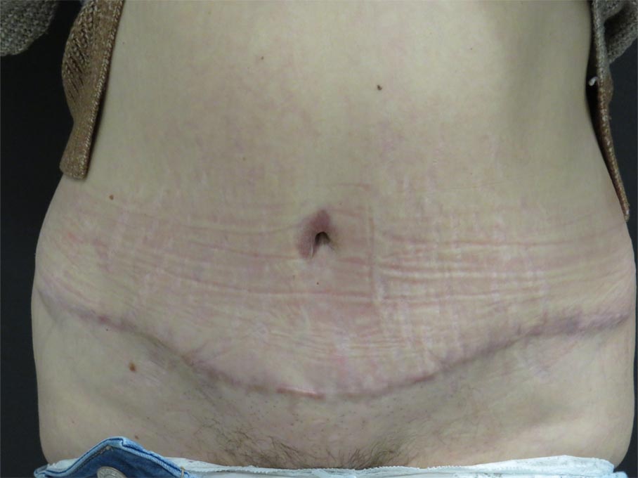 Nano-Fractional case #4975