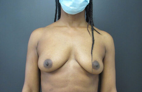 Breast Augmentation case #4969