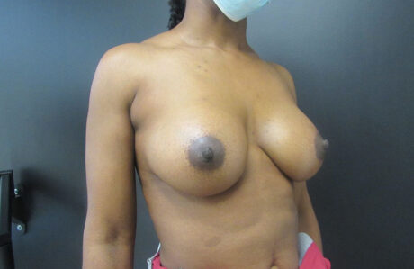 Breast Augmentation case #4969