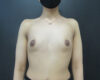 Breast Augmentation case #5010