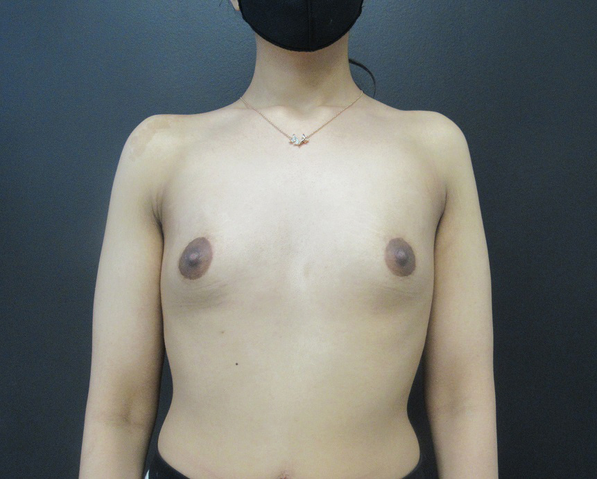 Breast Augmentation